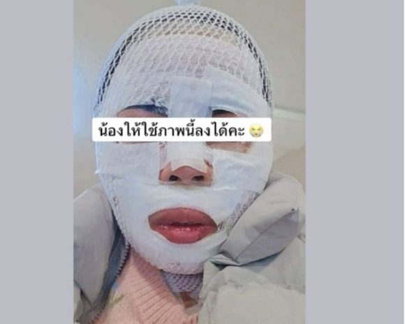 태국인 아내 얼굴에 끓는 물을 부어 다치게 한 남편이 항소심에서 감형받았다. 사진은 피해 태국인 여성. [사진=페이스북]